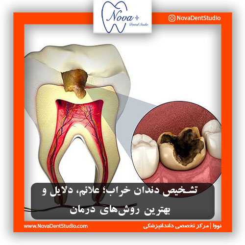 تشخیص دندان خراب؛ علائم، دلایل و بهترین روش‌های درمان