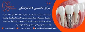 مدت زمان ایمپلنت دندان