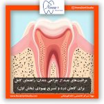 مراقبت‌های بعد از جراحی دندان؛ راهنمای کامل برای کاهش درد و تسریع بهبودی (بخش اول)