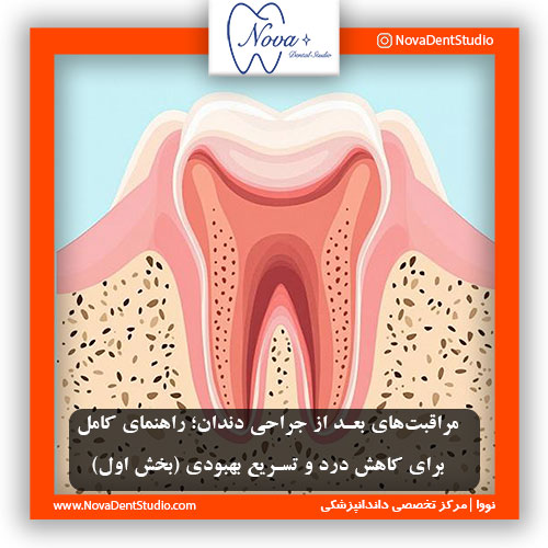 مراقبت‌های بعد از جراحی دندان؛ راهنمای کامل برای کاهش درد و تسریع بهبودی (بخش اول)