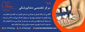 نکات طلایی قبل از کشیدن دندان عقل