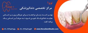هر چند وقت یک‌بار جرم‌گیری دندان لازم است