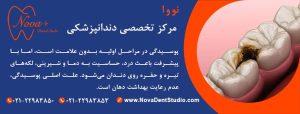 پوسیدگی دندان قبل از کامپوزیت
