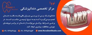 اهمیت ترمیم یا روکش بعد از عصب‌کشی