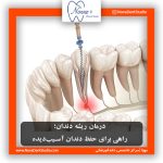 درمان ریشه دندان؛ راهی برای حفظ دندان آسیب‌دیده