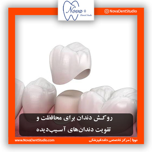 روکش دندان برای محافظت و تقویت دندان‌های آسیب‌دیده