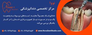 علائم آسیب پالپ و نیاز احتمالی به عصب‌کشی