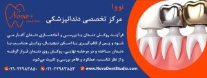 مراحل انجام روکش دندان